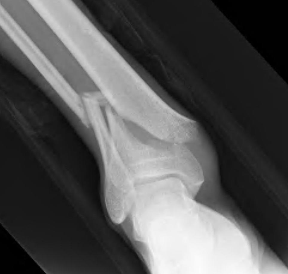 Distal tibial plate 1